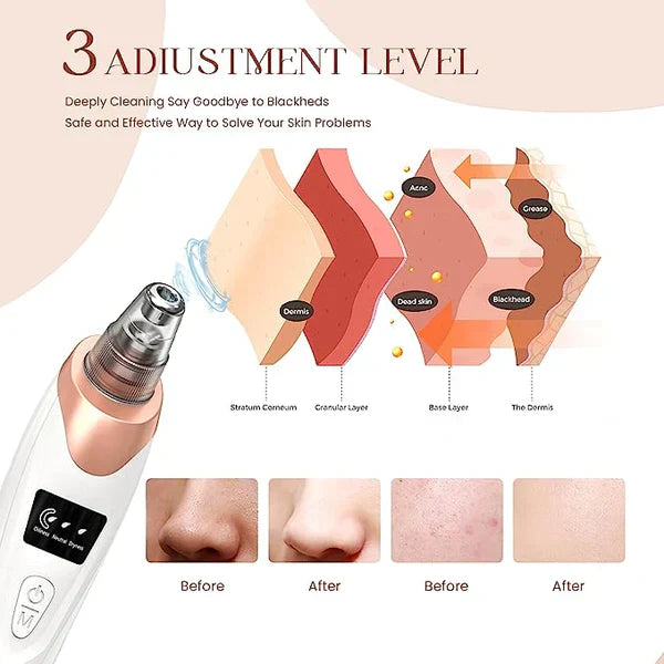 Electric Blackhead Remover Pore Vacuum Sucction machine - Binnoor Collection
